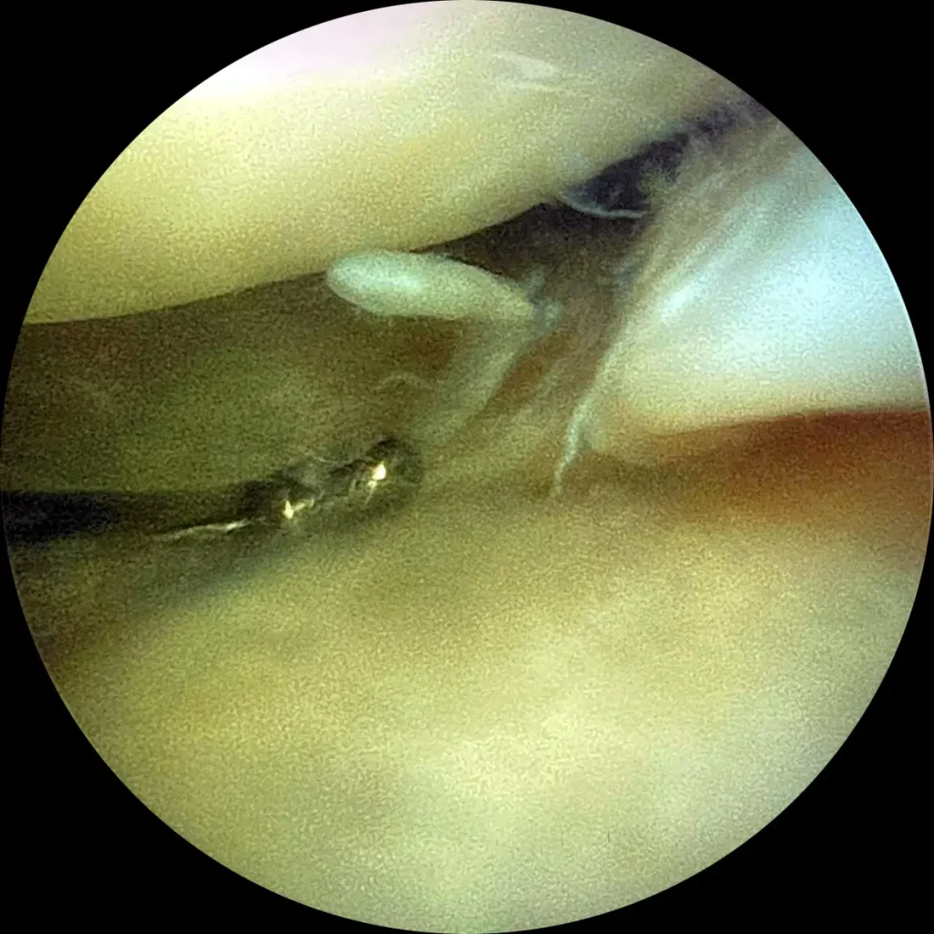 Le lesioni meniscali del ginocchio: tipologie, significato biologico e rilevanza clinica