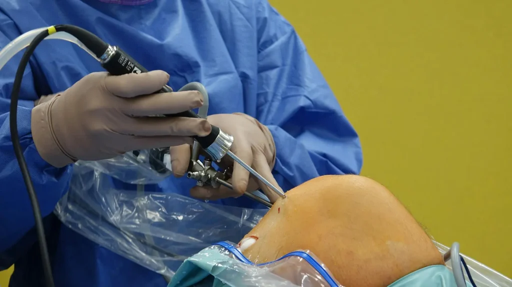 Trattamento delle lesioni meniscali